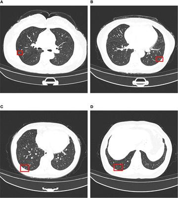 Case Report: Clinicopathological Analysis of Minute Pulmonary Meningothelial-Like Nodules: Report of 7 Cases